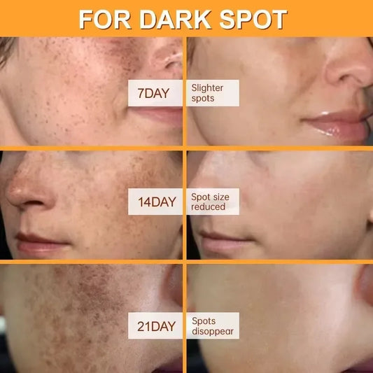 Whitening Freckles Face Cream Removal Melasma Dark Spots Corrector Lighten Melanin Pigmentation Brighten Anti-Aging Beauty Care