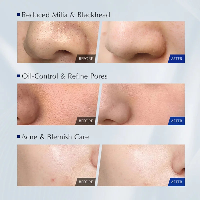Korean Facial Cleanser – Salicylic Acid + Niacinamide, Blue Lotus & Lotus Extract for Gentle Cleanse & Oil Balance